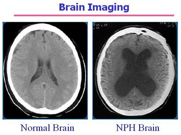 Billy Joel’s Battle with Brain Disorder: Understanding Normal Pressure Hydrocephalus