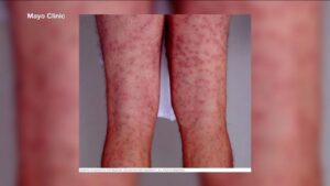 Health Officials Issue Warning About Swimmer’s Itch at Greenwich Beach