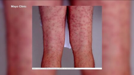 Health Officials Issue Warning About Swimmer’s Itch at Greenwich Beach